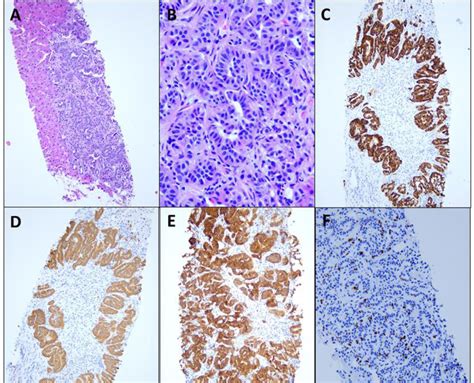 Pathology From A Random Liver Biopsy Confirmed Diffuse Infiltrative
