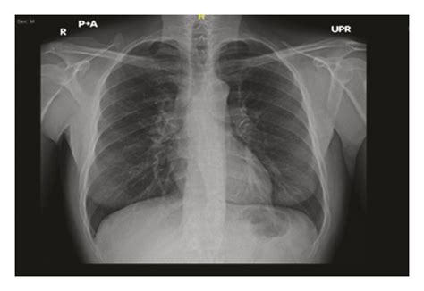Chest X Ray Showing Bilateral Hilar Lymphadenopathy Download