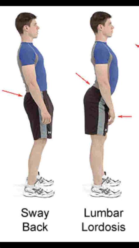 Postural Defects That Affect The Spine Or Backbone