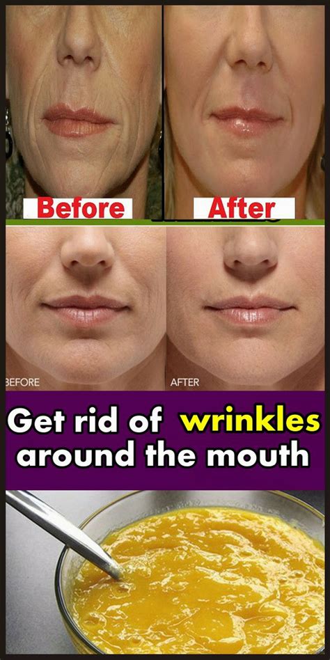 Get Rid Of Wrinkles Around The Mouth