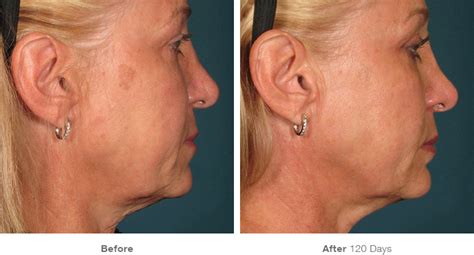 Ultherapy Or Thermage Non Surgical Skin Tightening Treatment