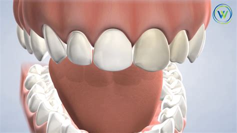 Dental Implants Archives Winterholler Dental Implants And Cosmetic Dentistry