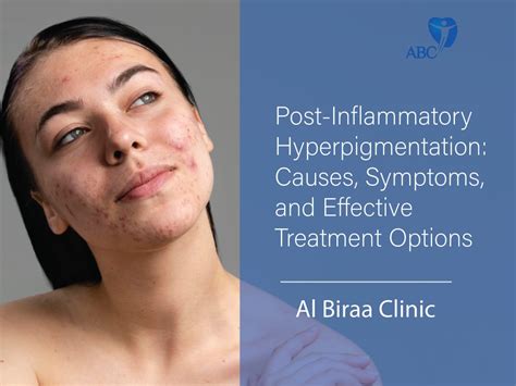 Understanding And Treating Post Inflammatory Hyperpigmentation