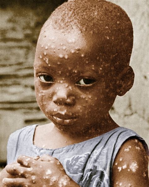 Child With Smallpox Poster Print By Science Source