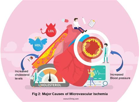 Microvascular Ischemic Disease Symptoms Causes Diagnosis