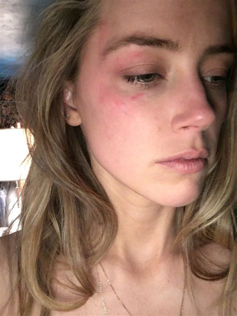 Court Sees Photos Of Amber Heards Bruised Face