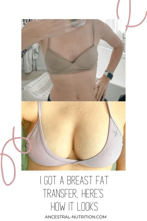 Reviews Of Fat Transfer To Breast In India Spears Poseed