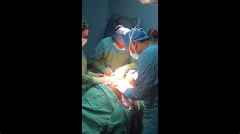 Circumferential Tummy Tuck 360 Derece Karın Germe Youtube