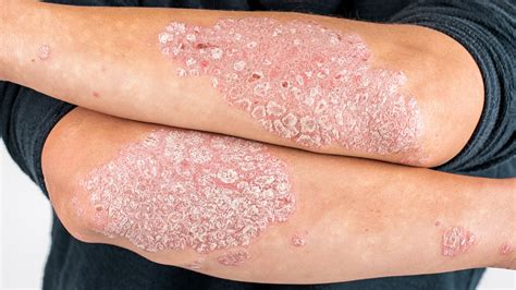 Manage And Understand Your Psoriasis — New River Dermatology