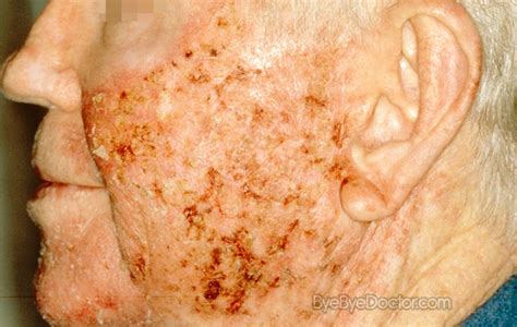 Actinic Keratosis Pictures Symptoms Causes Treatment And Prevention Images