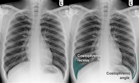 Chest X Ray Anatomy Costophrenic Recesses And Angles