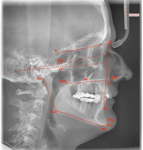 Lateral Cephalometric Radiograph With Landmarks Lines And Angles Red
