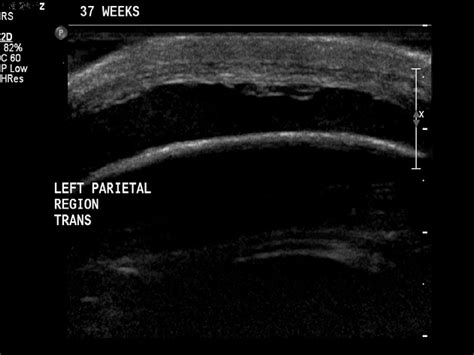 Cephalohematoma Ultrasound