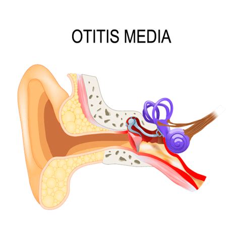 Ear Infection Ear Nose And Throat Care Center