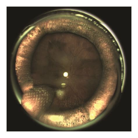 A Fundus Image Of The Patient With A Circular Scleral Buckle Csb