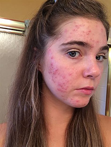 Twins With Cystic Acne Cleared It In 3 Days