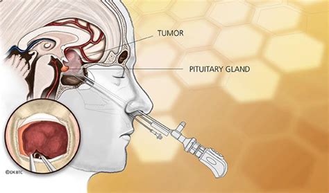 the resilient pituitary gland what happens when the pituitary gland has to be cut during