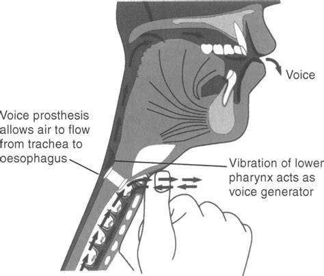 Tracheo Oesophageal Voice Of Prosthesis Download Scientific Diagram