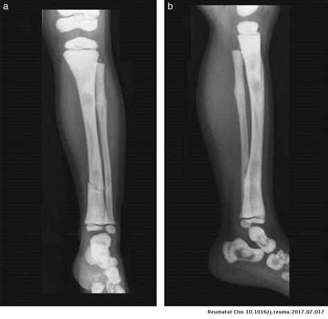 Hallazgos Radiológicos En La Osteopetrosis Infantil Autosómica Recesiva
