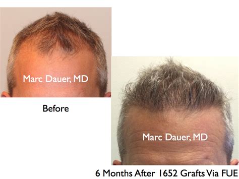 Fue Hair Transplant Results And Donor Zone After 6 Months Marc Dauer