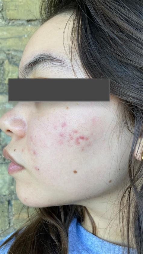 Can Anyone Help Me With My Acne Scars Post Inflammatory Erythema R