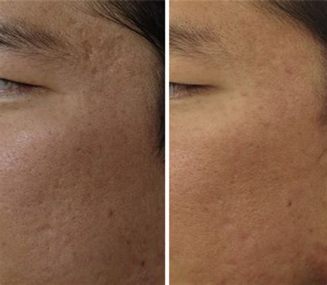 Acne Scars Can Now Be Improved Nicely With Modern Lasers