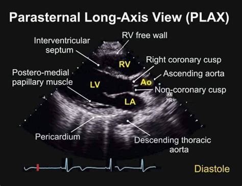 Parasternal Long Axis View Tee Echocardiogram Diagnostic Medical