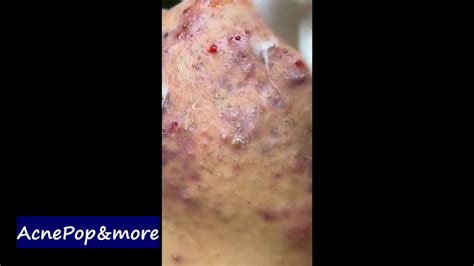 Acne And Blackhead Extraction Cystic And Infected Acne Part 1 Youtube