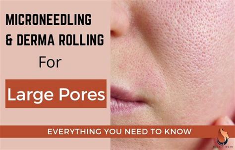 Microneedling And Derma Rolling For Large Pores Full Guide Sasily Skin