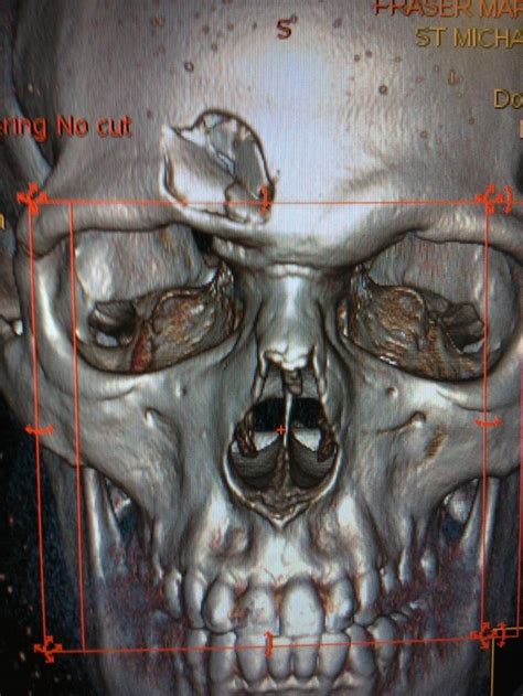 Find 1,585 synonyms for slap in the face and other similar words that you can use instead based on 6 separate contexts from our thesaurus. Disturbing Image: Mark Fraser's CT Scan After Taking Slap ...