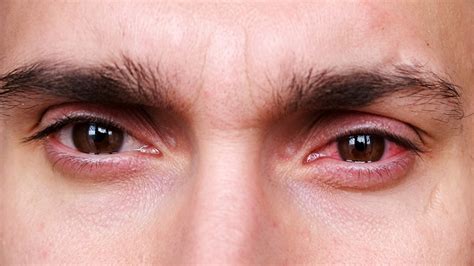Symptoms Of Sunburned Eye