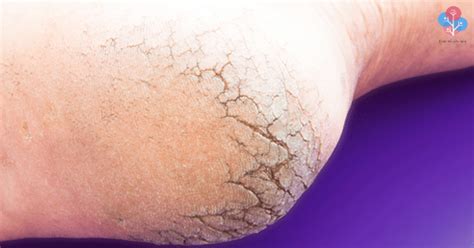 Forget About Dry And Cracked Or Itchy Feet By Using This Simple Ingredient