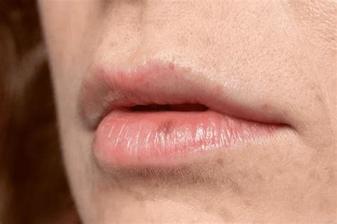 Causas De Labios Hinchados