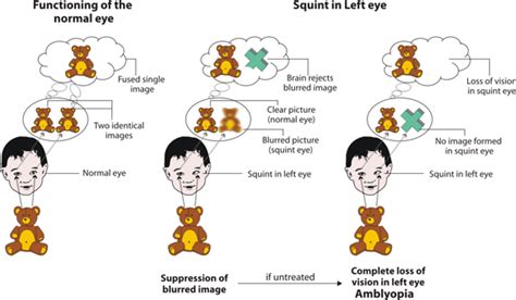 How To Fix Lazy Eye Amblyopia Evershine Optical