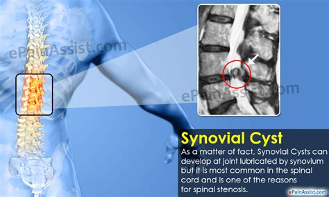 What Is Synovial Cyst And How Is It Treated