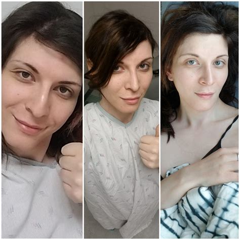 I changed so much in 2019. I had FFS twice this year. Feb 6 right