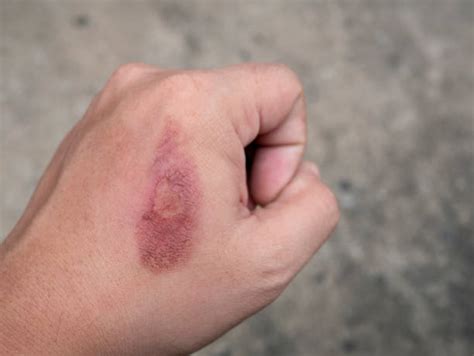 13600 Skin Burn Stock Photos Pictures And Royalty Free Images Istock