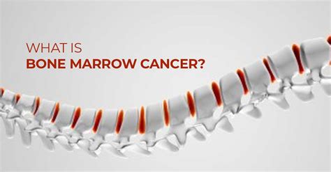 Symptoms And Diagnosis Of Bone Marrow Cancer We Need To Know - Marham