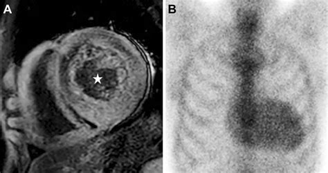 Figure3a Late Gadolinium Enhanced Cardiac Magnetic Resonance Imaging