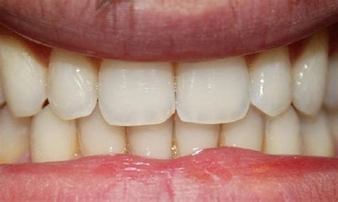 Frenectomy And Invisalign Before And After Images Tysons Dentistry