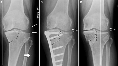 Tibial Condylar Valgus Osteotomy Tcvo For Osteoarthritis Of The Knee