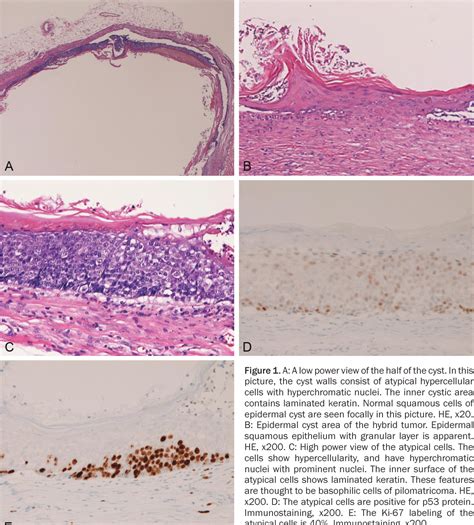 Figure 1 From Cutaneous Hybrid Tumor Composed Of Epidermal Cyst And