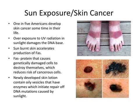 Ppt Sun Exposureskin Cancer Powerpoint Presentation Id1910524