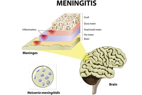 The 3 Pathogens That Cause Meningitis