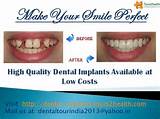 Dental Insurance For Implants Photos
