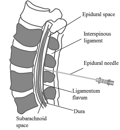 Graphical Representation Of The Epidural Space And Surrounding Anatomy