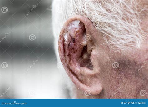 Ear Wound Stock Photo Image Of Medicine Color Patient 97151996