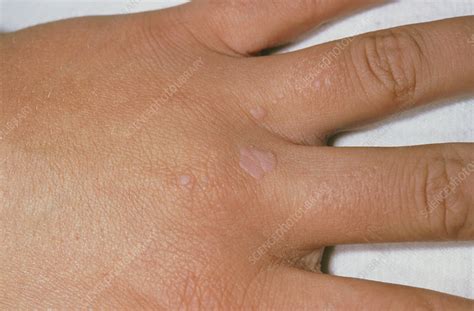 Common Warts On The Hand Stock Image M2900059 Science Photo Library