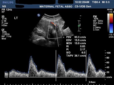 Uterine Artery Doppler Maternal Fetal Associates Of The Mid Atlantic