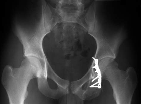 Avulsion Fracture Of The Ischial Tuberosity In Adolescents—an Easily